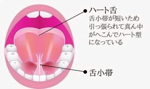 舌小帯短縮症の画像